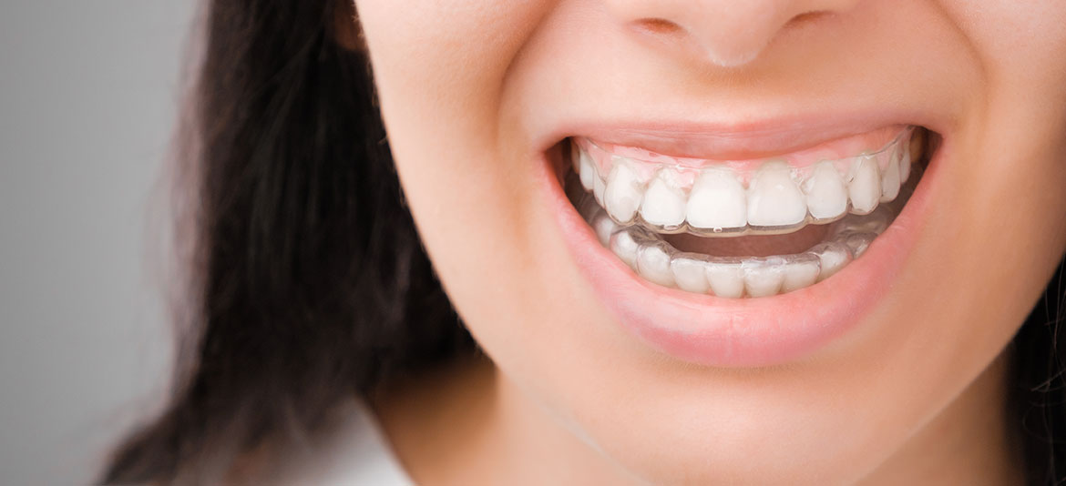 Diferencias entre alineadores prescritos por un ortodoncista y alineadores directos al consumidor